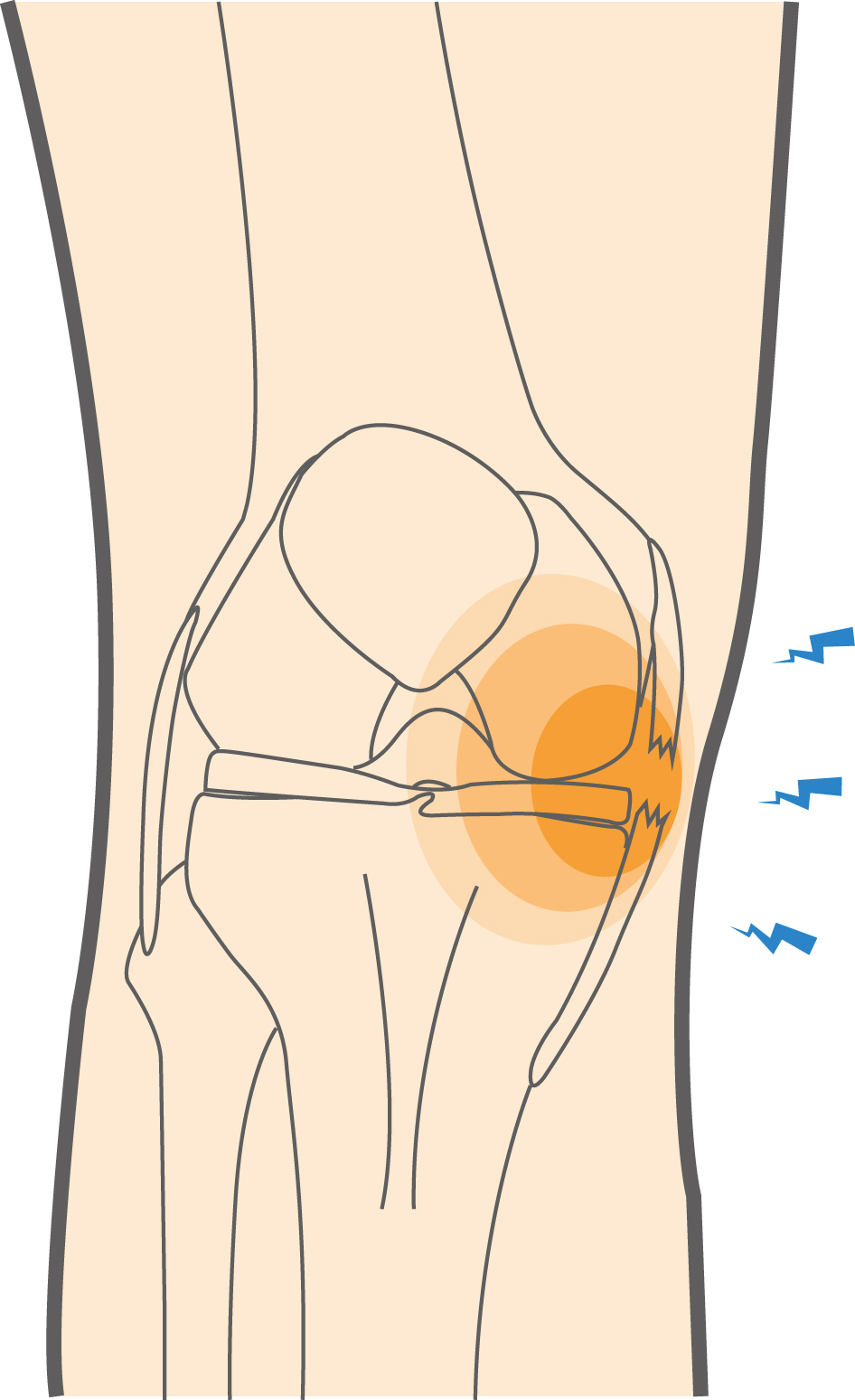 Medial Collateral Ligament (MCL) Tears Hero Image 2