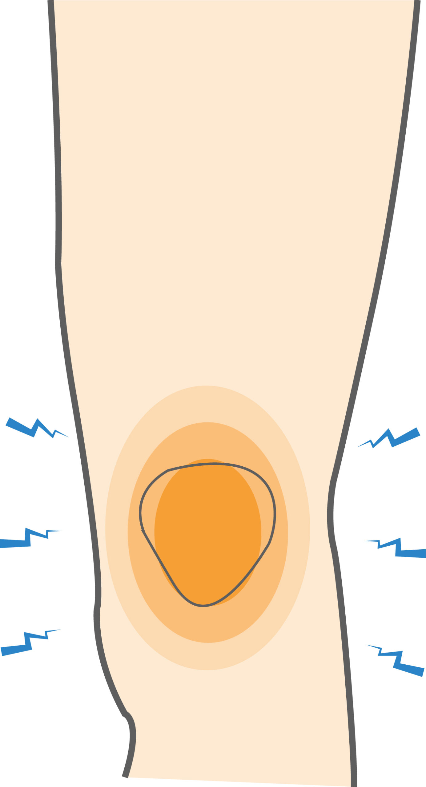 What's The Best Type of Brace For Knee Pain? - PainHero