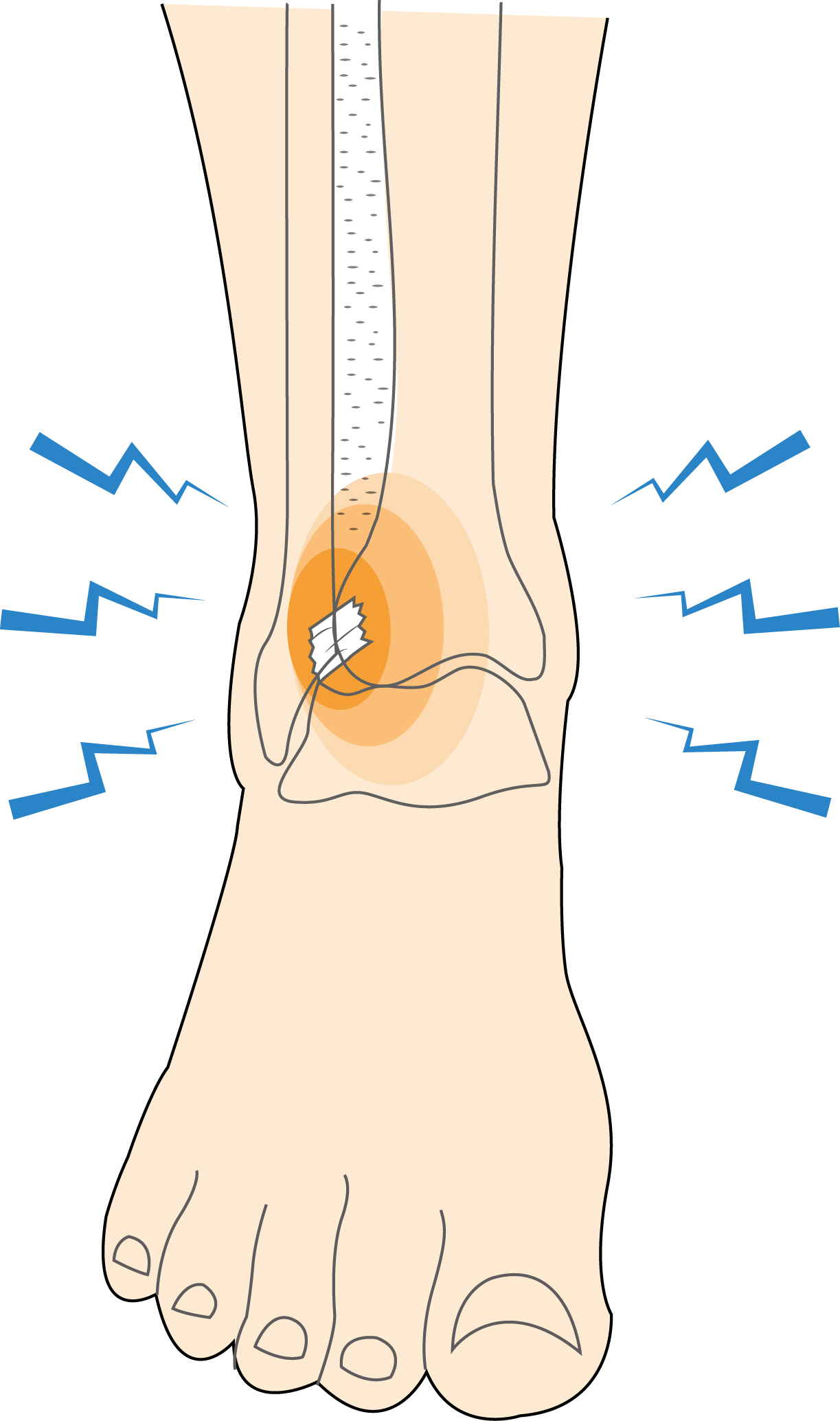 Ankle Sprain (Syndesmotic) Hero Image 2