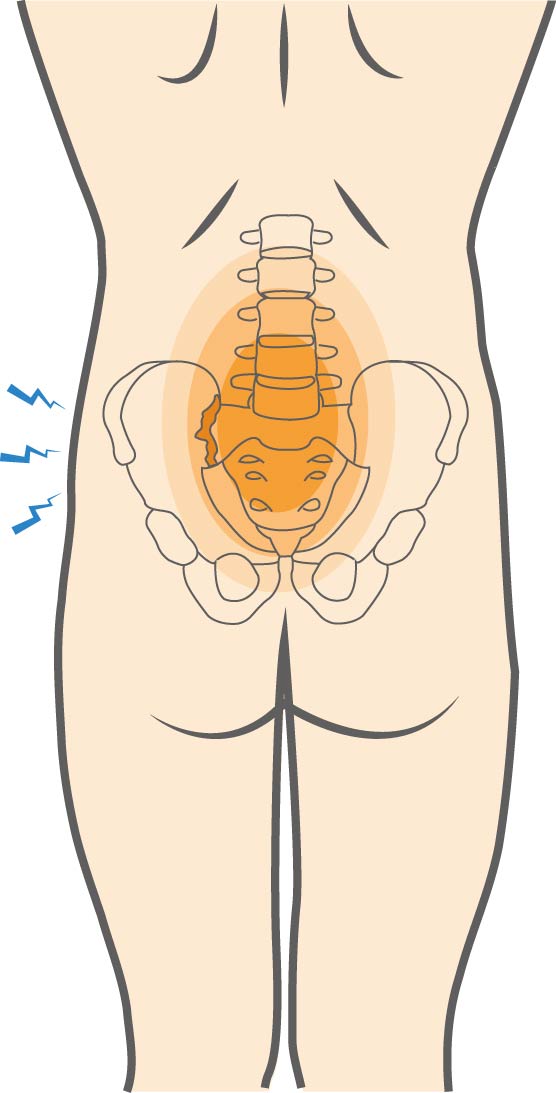 What does sacroiliac joint pain feel like?