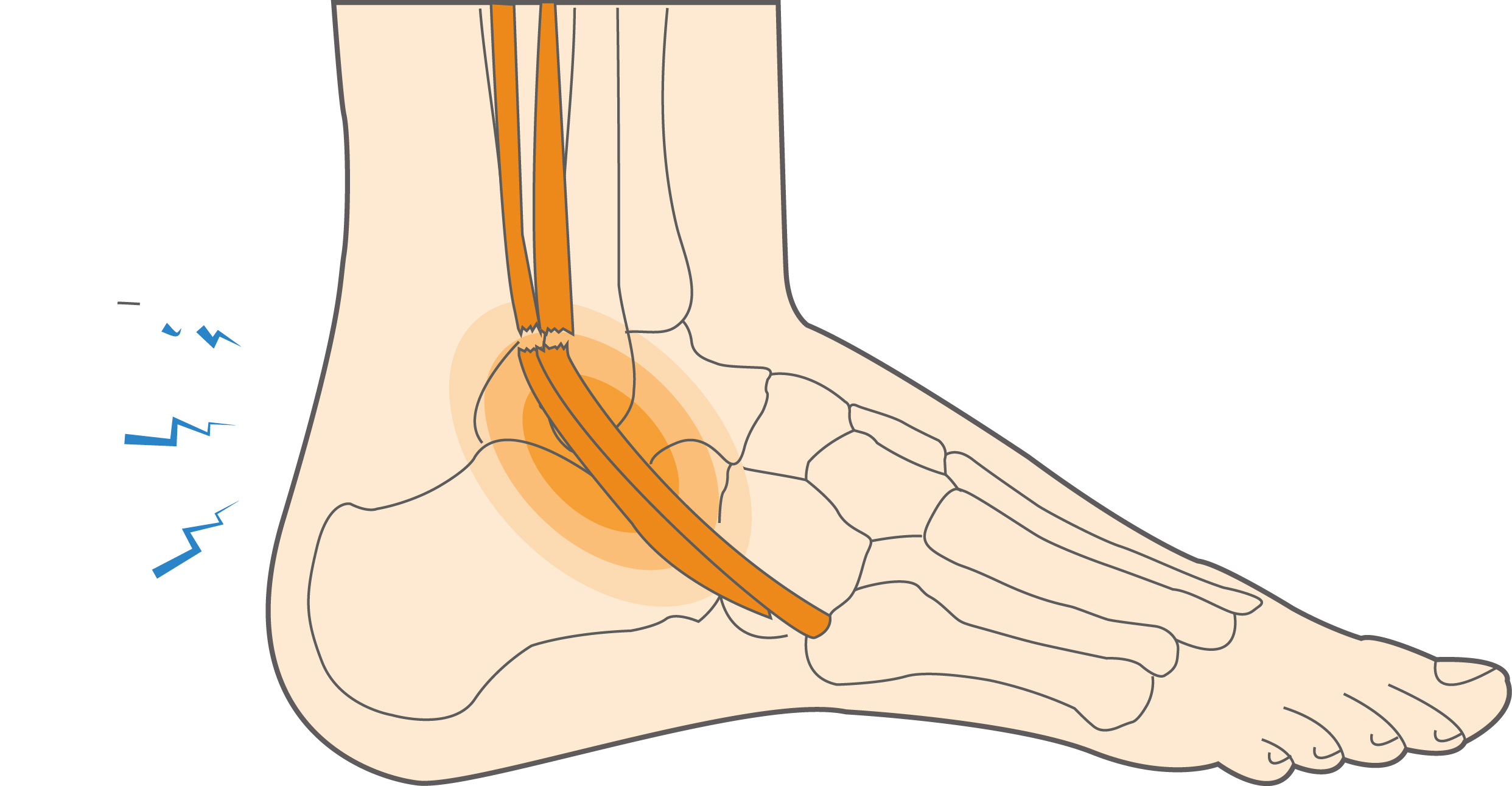 torn tendon in ankle symptoms