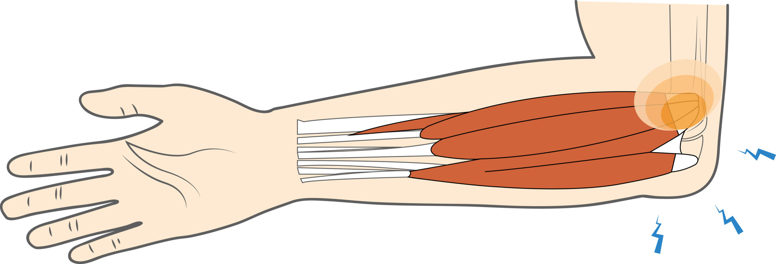 Medial Epicondyle Of Humerus Pain