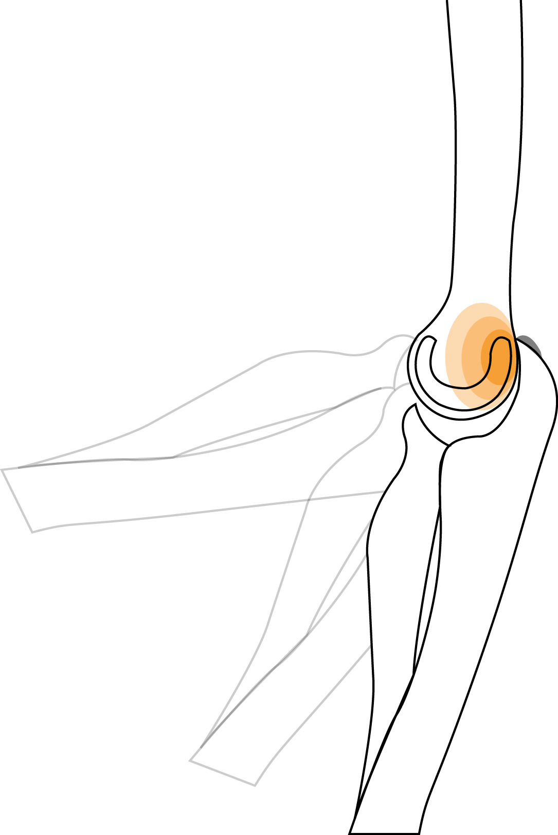 Posterior Impingement Syndrome of elbow Hero Image 2