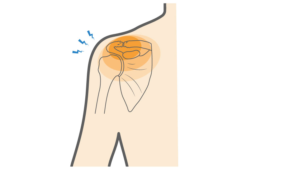 Acromioclavicular Osteoarthritis