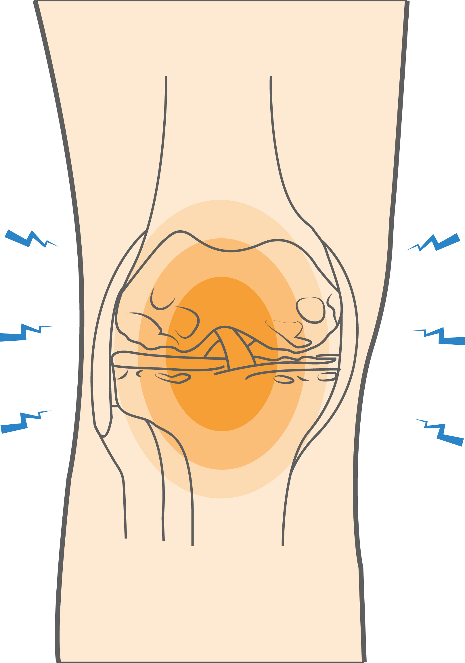 Knee Arthritis Hero Image 2