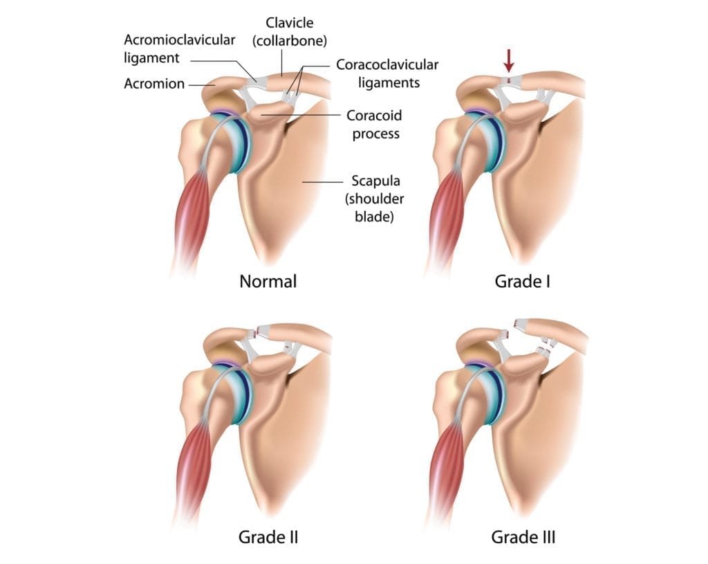 acromioclavicular joint AC Separation