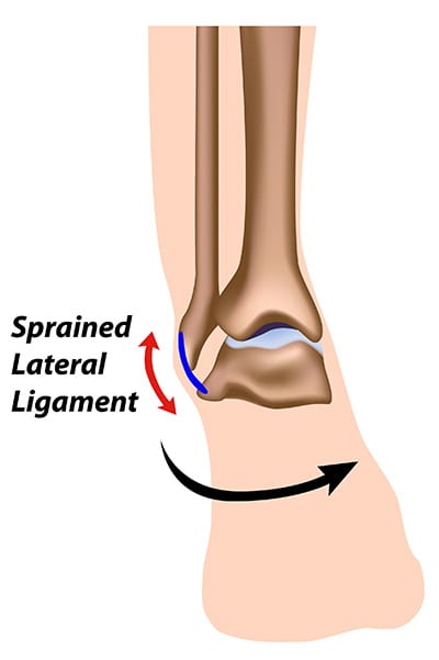 Ankle Sprain (Lateral) Hero Image 2
