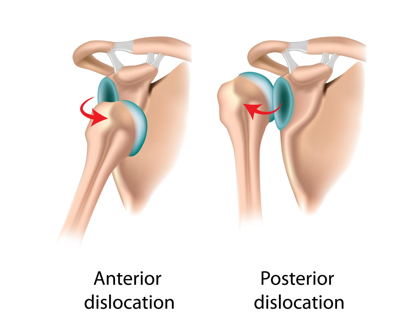 Shoulder Instability Hero Image 2