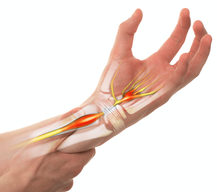 Carpal Tunnel Syndrome Summary