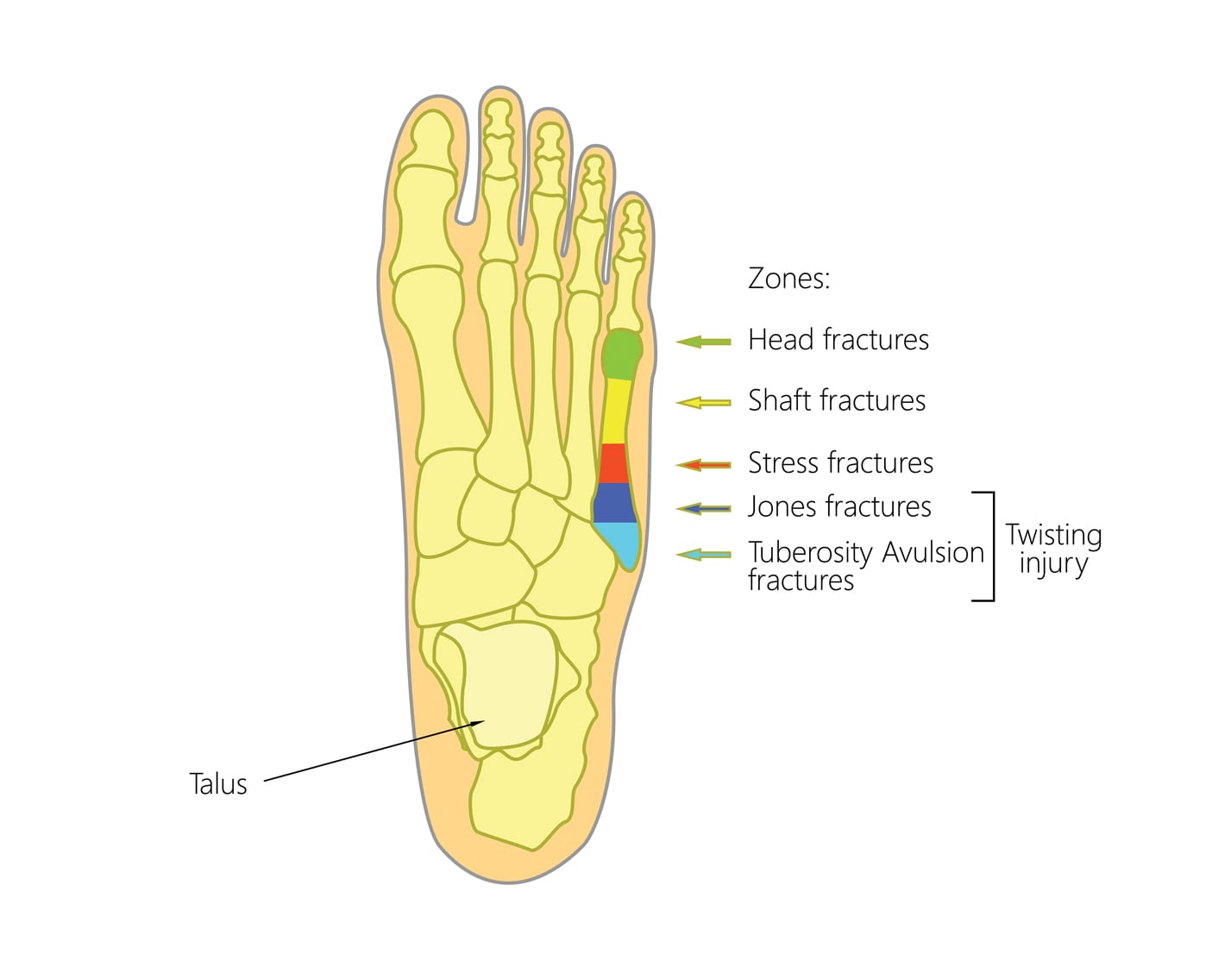 5th metatarsal fracture symptoms