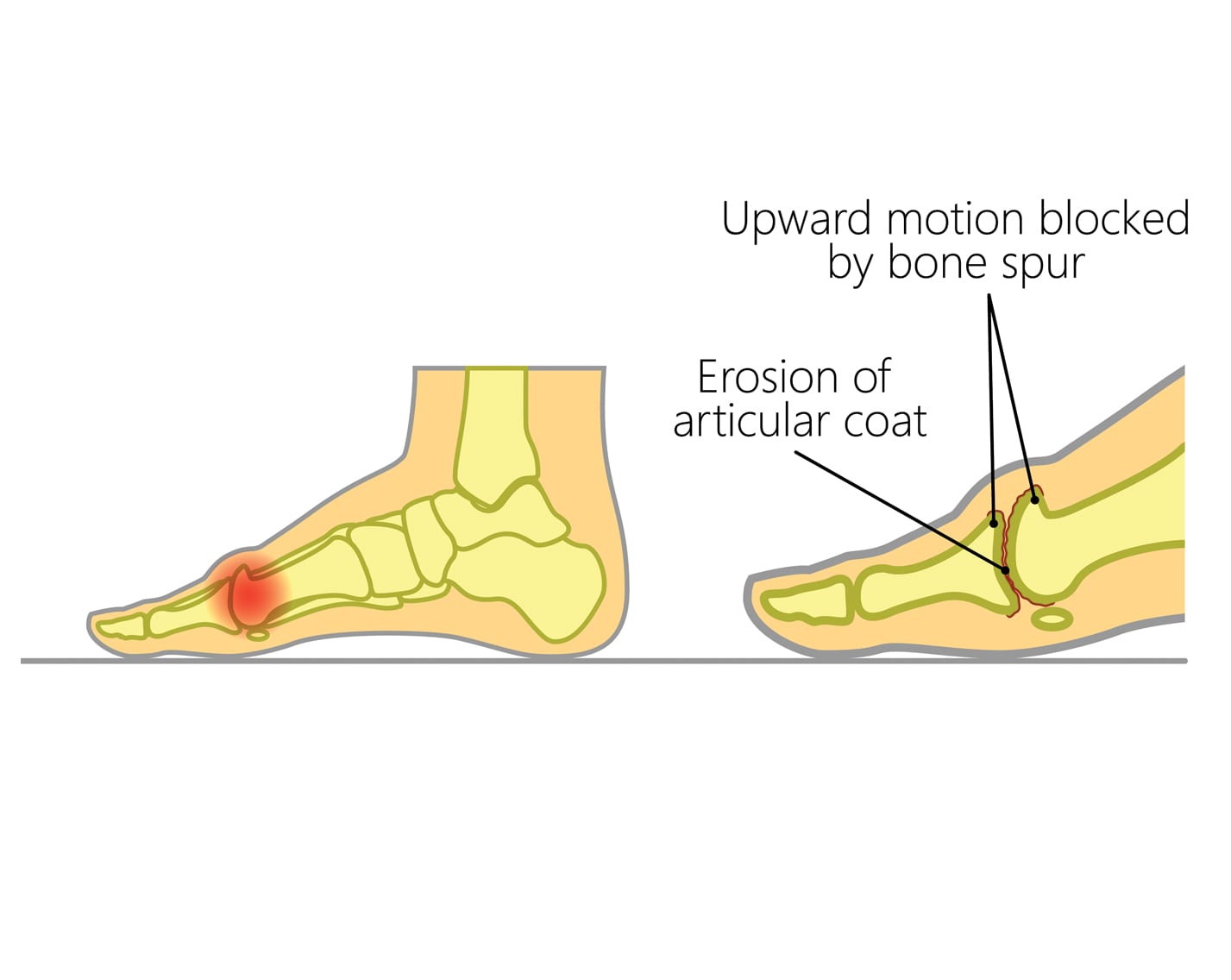 What Is Hallux Rigidus Its Impact On Toe Movement Upswing Health