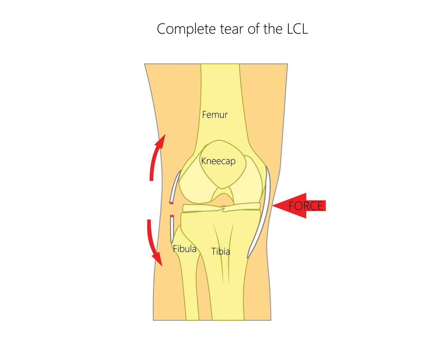 Lateral Collateral Ligament Knee Injury