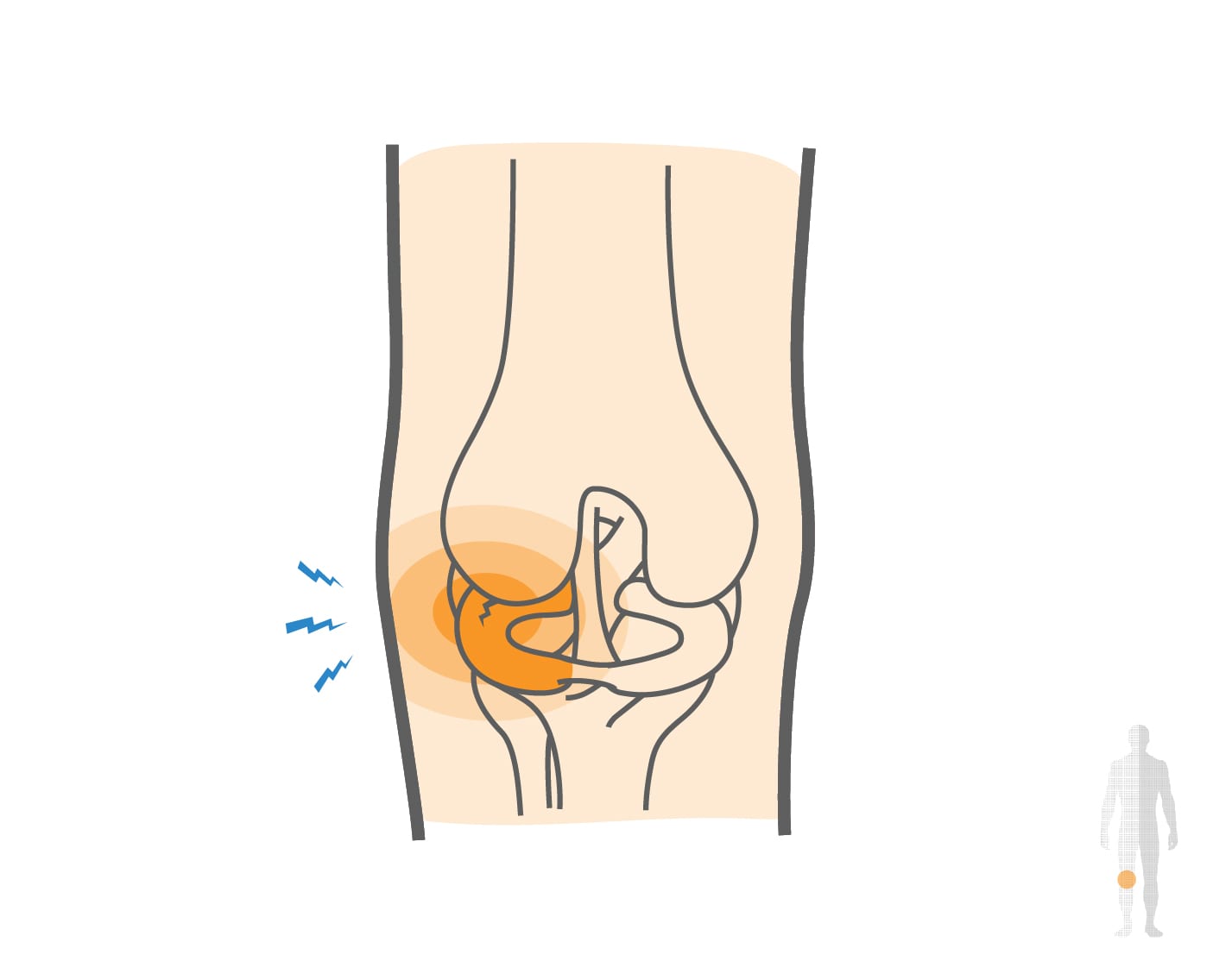 Lateral Meniscus Tears Hero Image 2