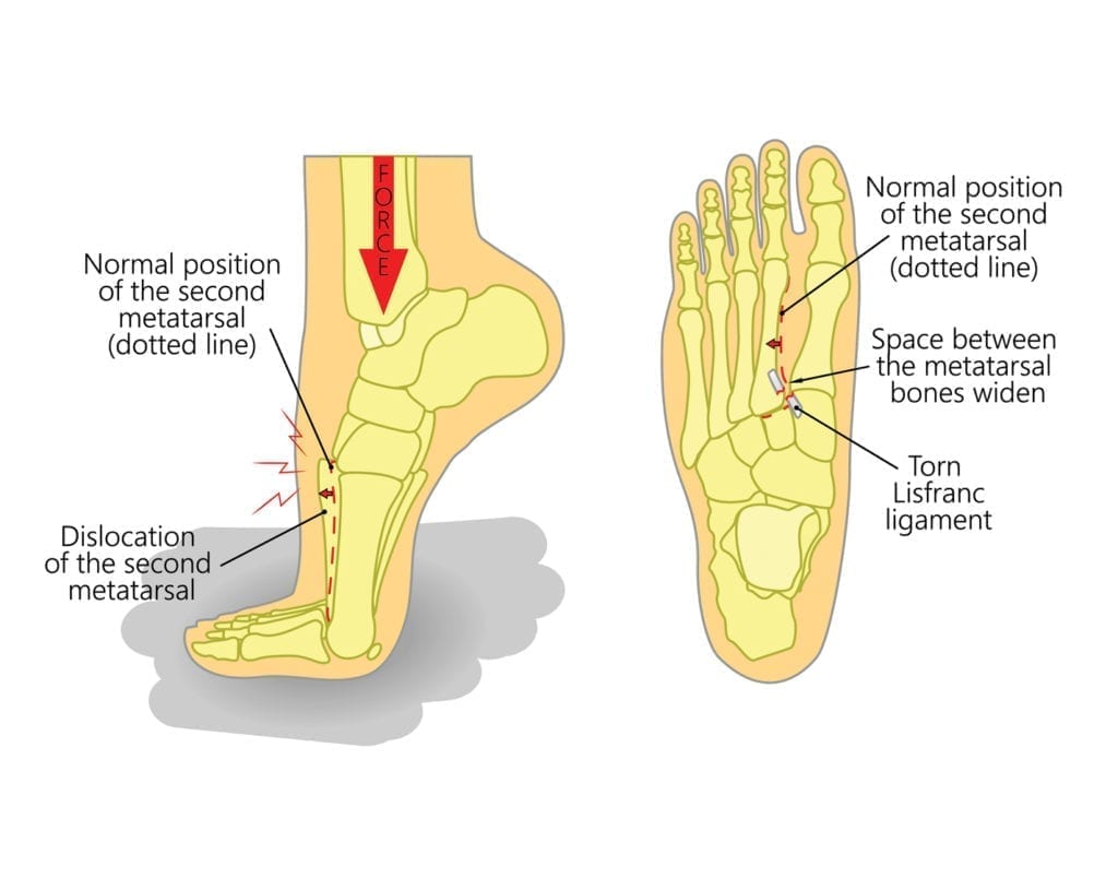 What is Lisfranc Injury & How to Manage Foot Pain? - Upswing Health
