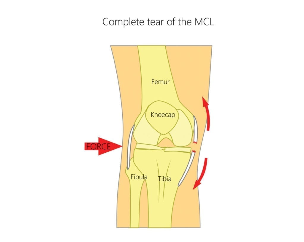 Medial collateral ligament or MCL injury of the knee: what to do