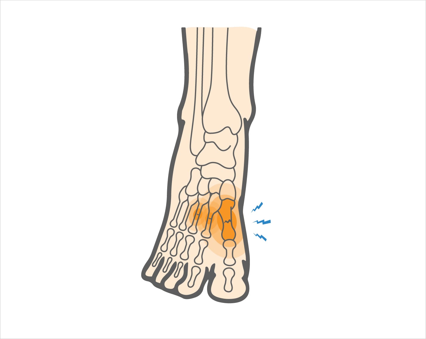 metatarsal fracture