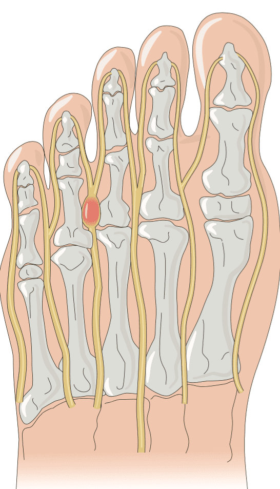 Morton’s Neuroma Hero Image 2