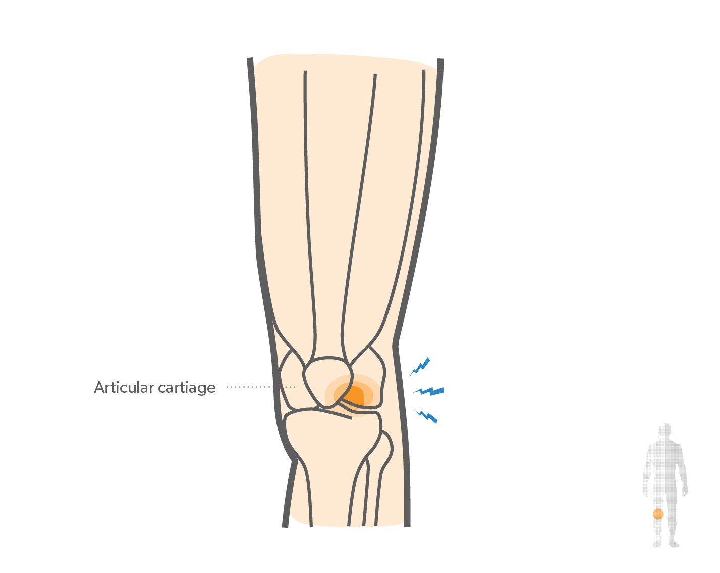 Osteochondritis Dissecans of the Knee Hero Image 2