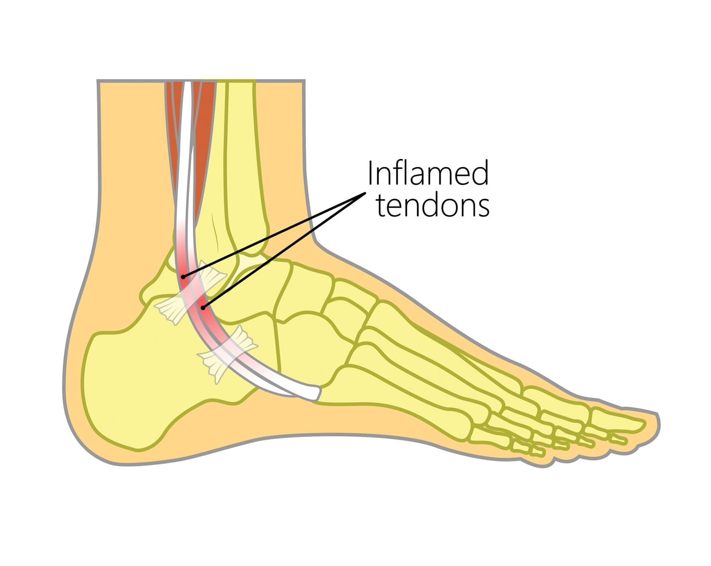 Crushed tendon in foot