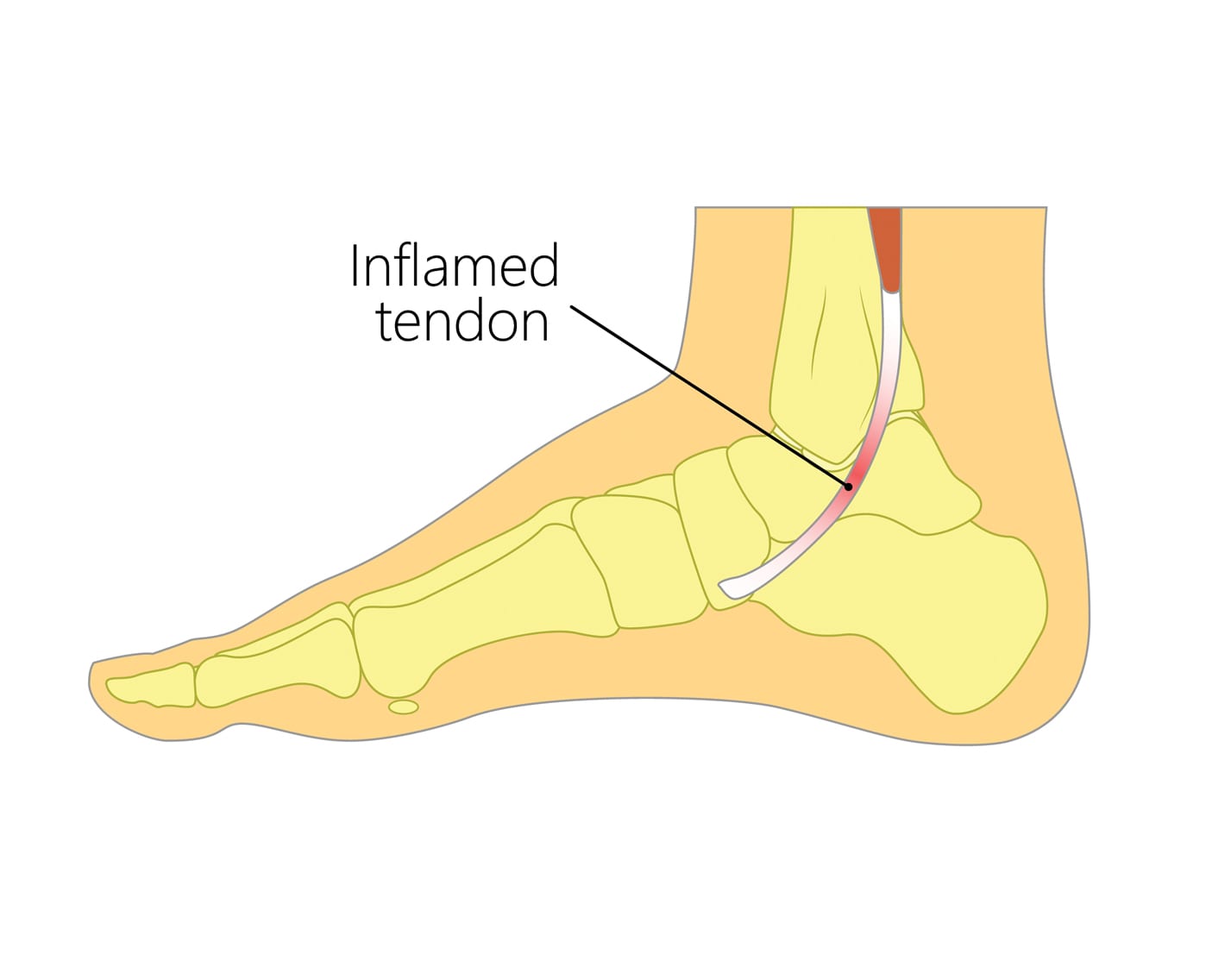 Posterior Tibial Tendonitis Upswing Health