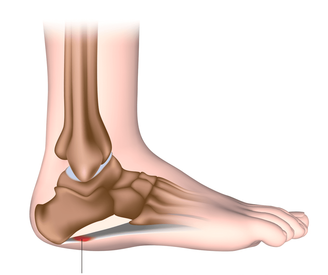 Plantar Fasciitis Hero Image 2