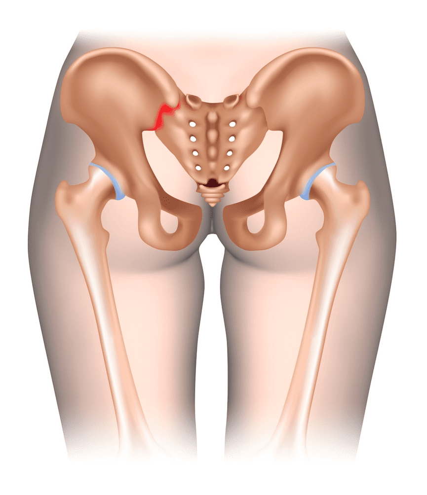 sacroiliac ligament pain