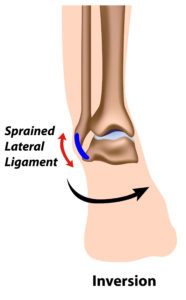 Sprained Ankle - OrthoInfo - AAOS