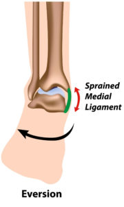 medial ankle sprain