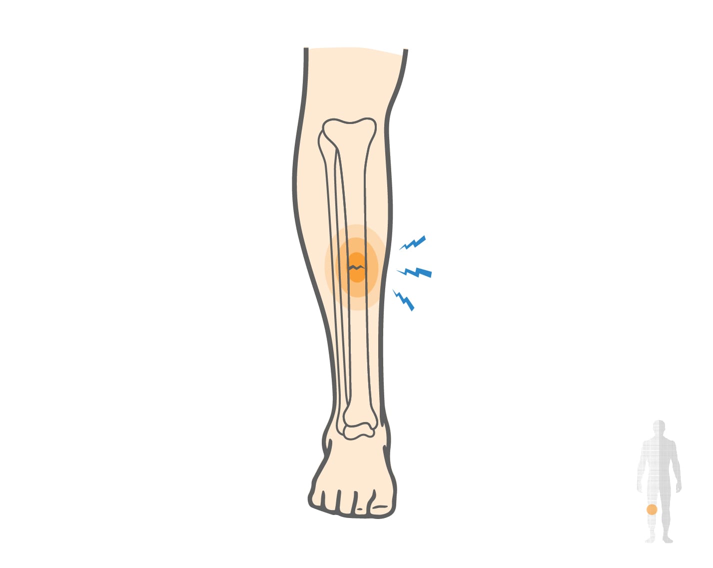 Stress Fracture of the Tibia - Upswing Health | Upswing Health