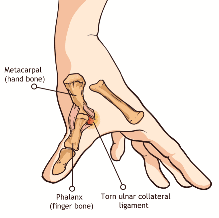 break your thumb ligament