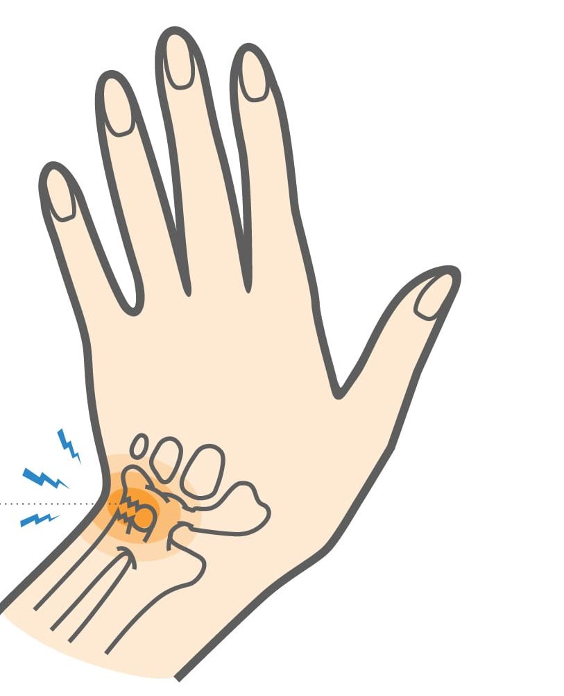 What Is A Triangular Fibrocartilage Complex TFCC Tear How 50 OFF