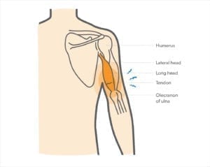 tendon triceps elbow tear muscle connects result