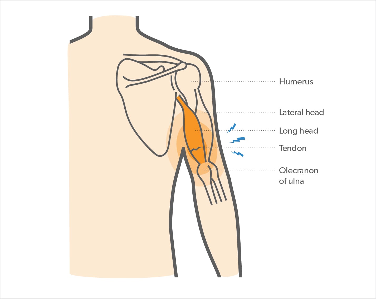 Torn Triceps: Symptoms, Causes, Risk Factors, Treatment