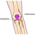 Posterior Impingement Syndrome