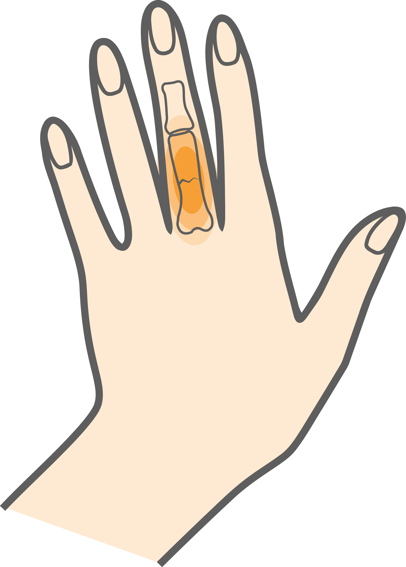 Finger Fracture Hero Image 2