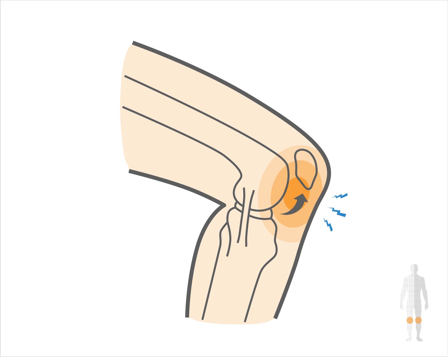 Patella Tendonitis Hero Image 2