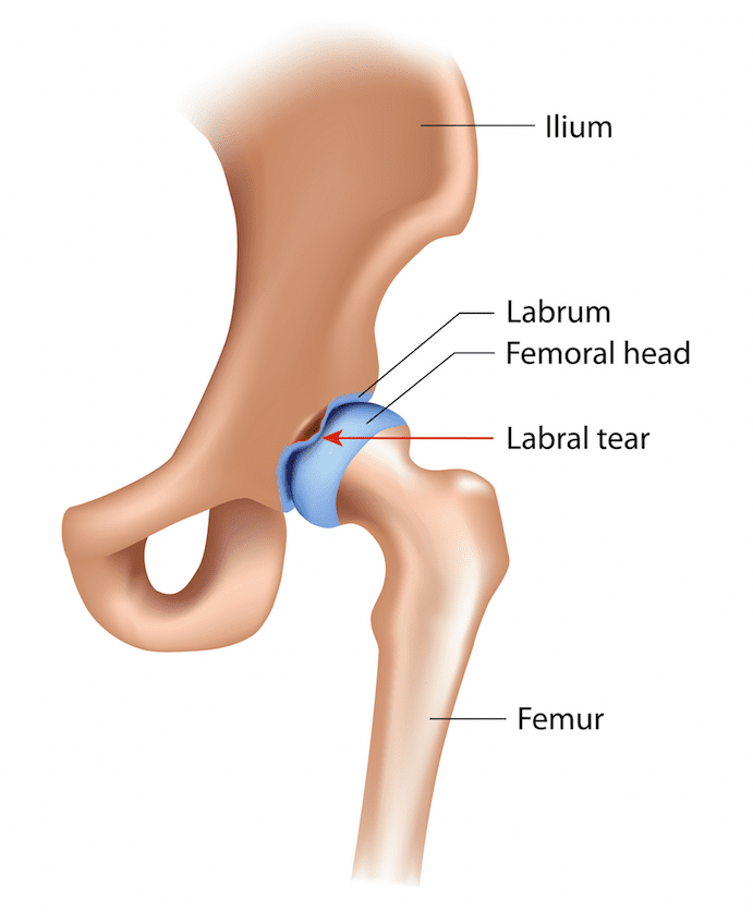 Labral Tear Hip