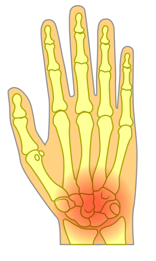 Wrist Arthritis Hero Image 2