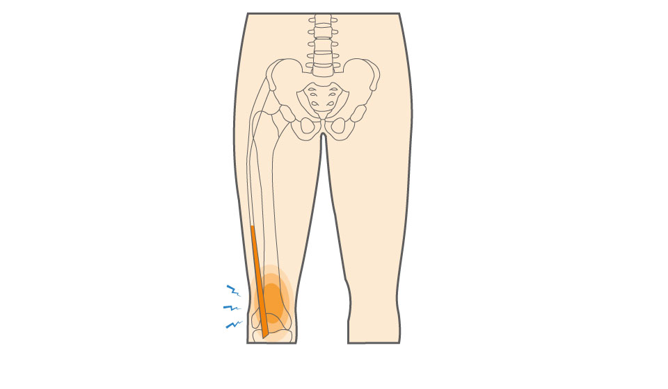 Iliotibial (IT) Band Tendonitis of the Knee Hero Image 2