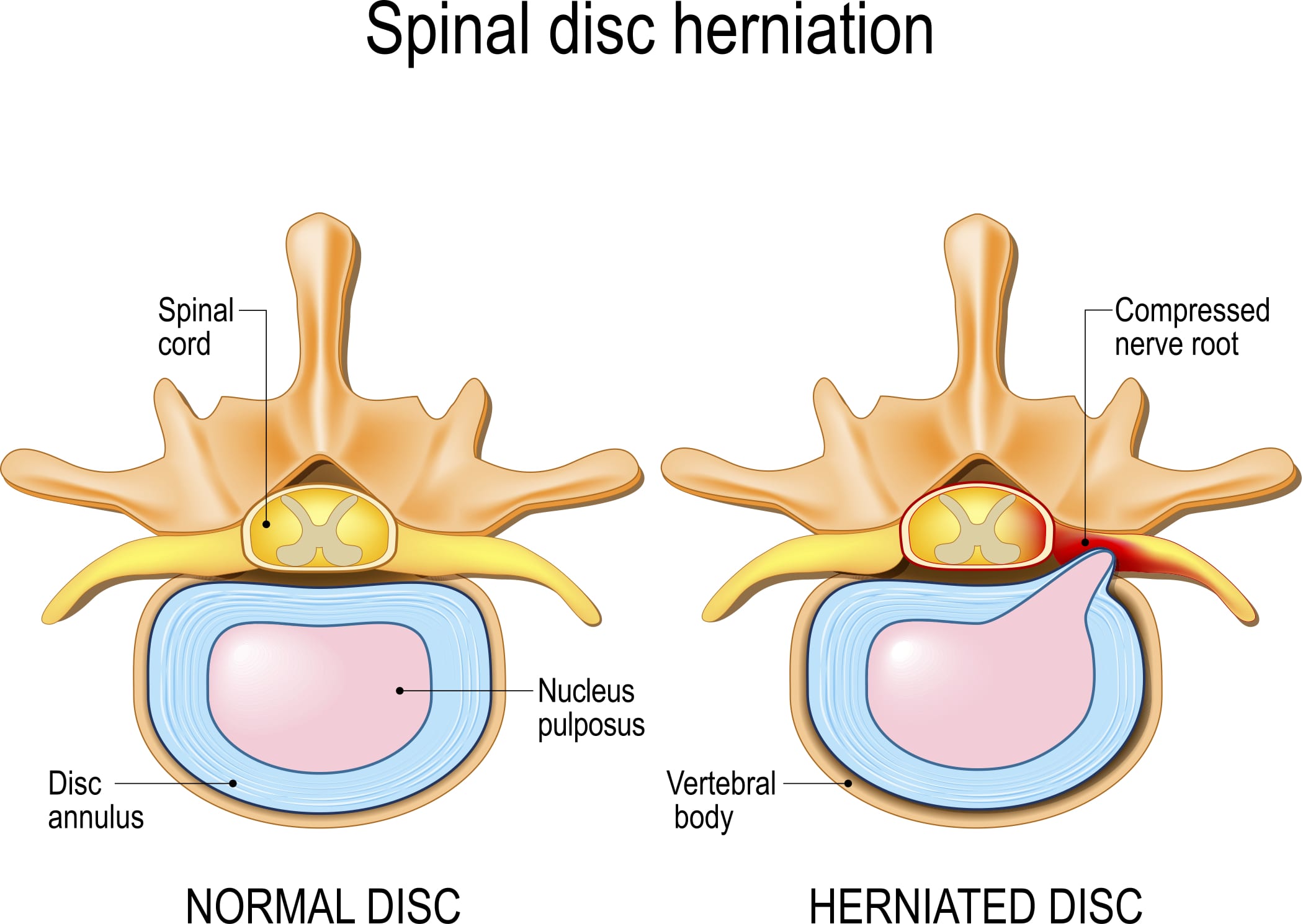 Cervical Disc Herniation | Upswing Health