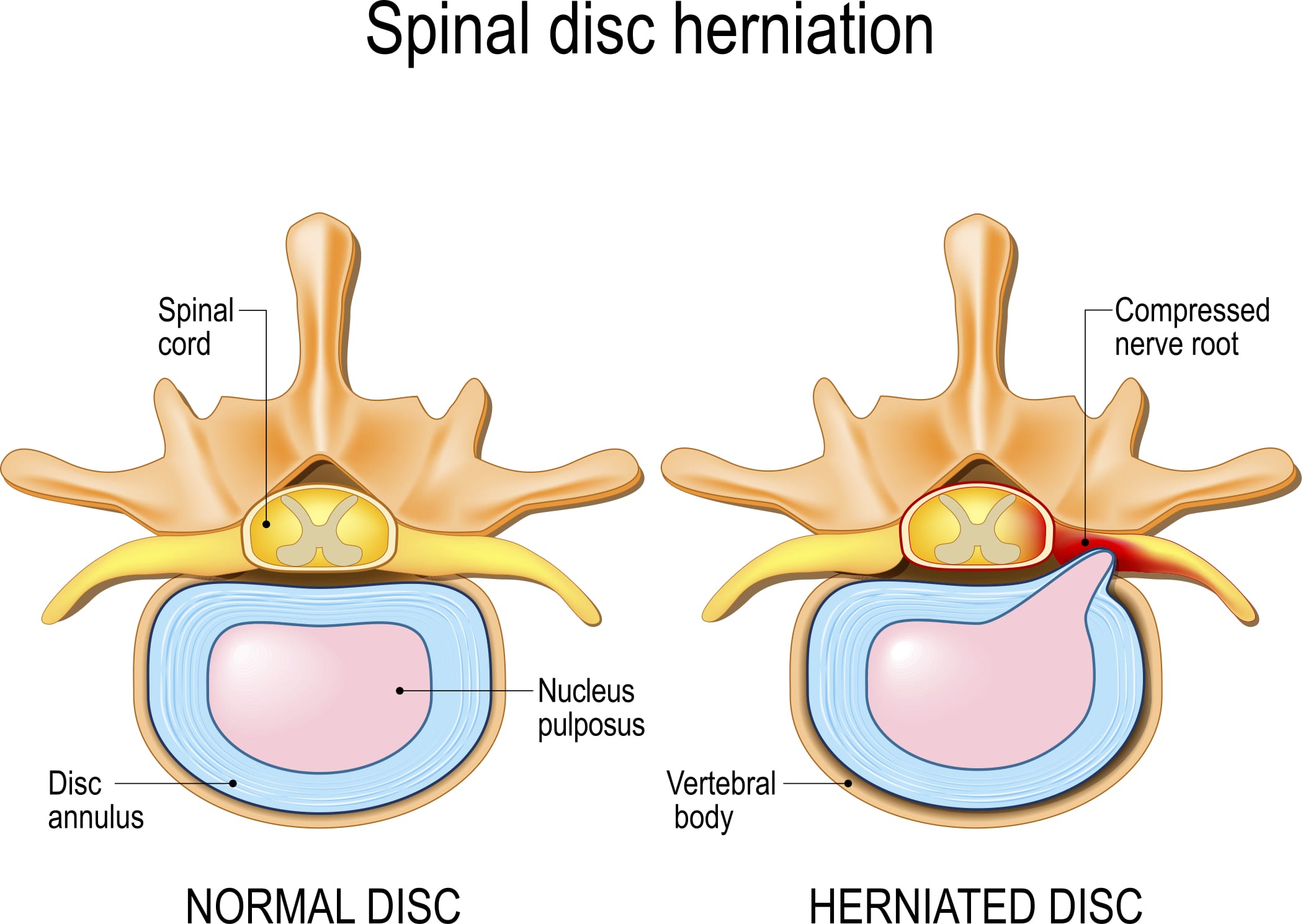 5 herniated discs in back