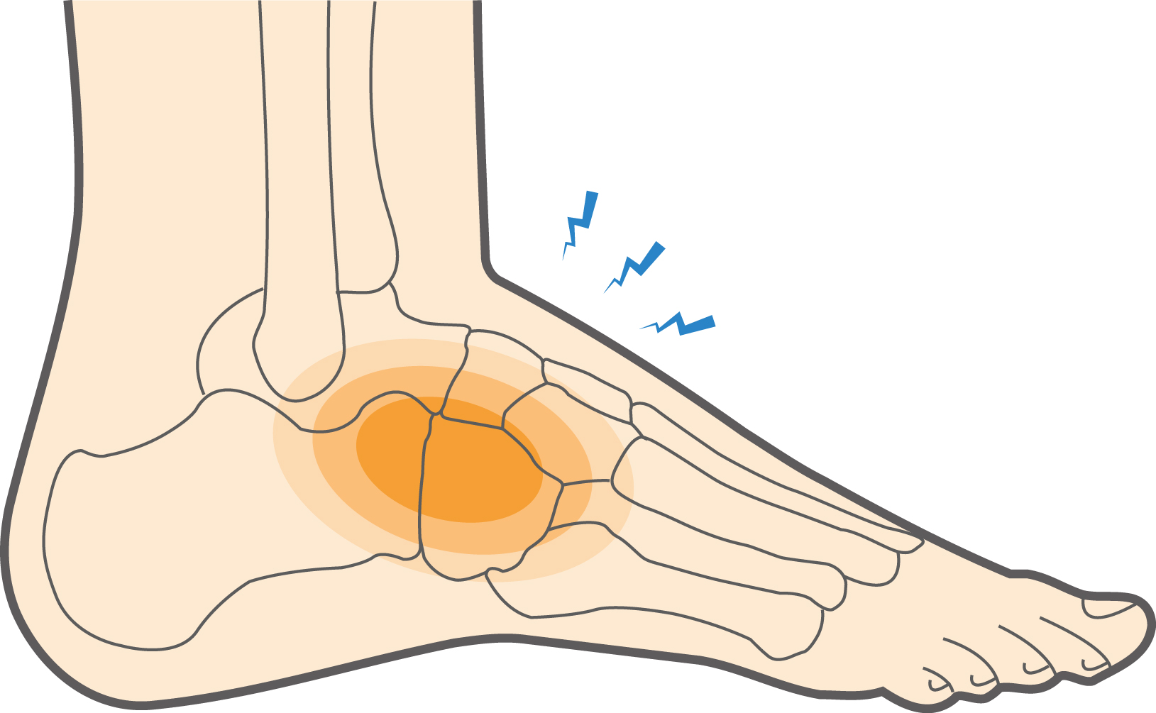 What Is A Midfoot Sprain How To Address This Foot Injury 56 OFF