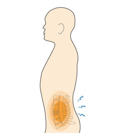 Degenerative Disc Disease (Lumbar Spine) Hero Image 2
