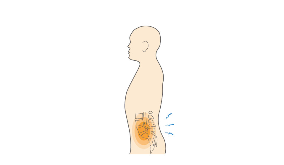 Spondylolysis/Spondylolisthesis Hero Image 2