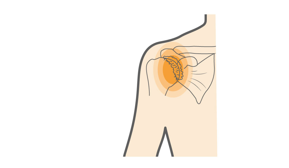 Arthritis of the Shoulder - OrthoInfo - AAOS