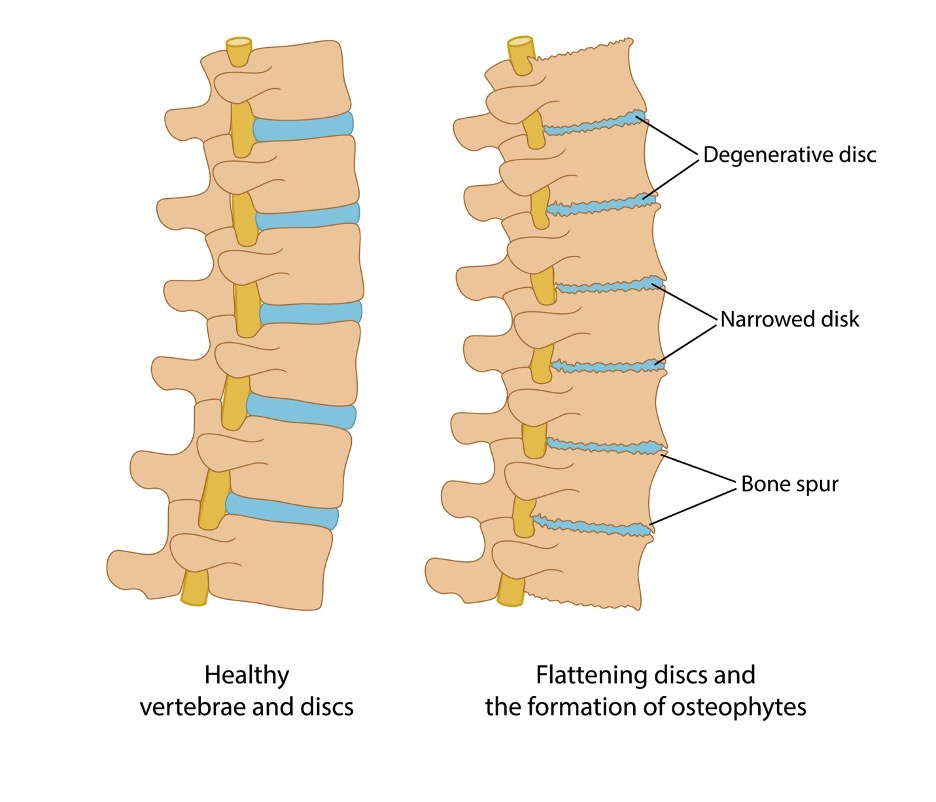 degenerative osseous changes