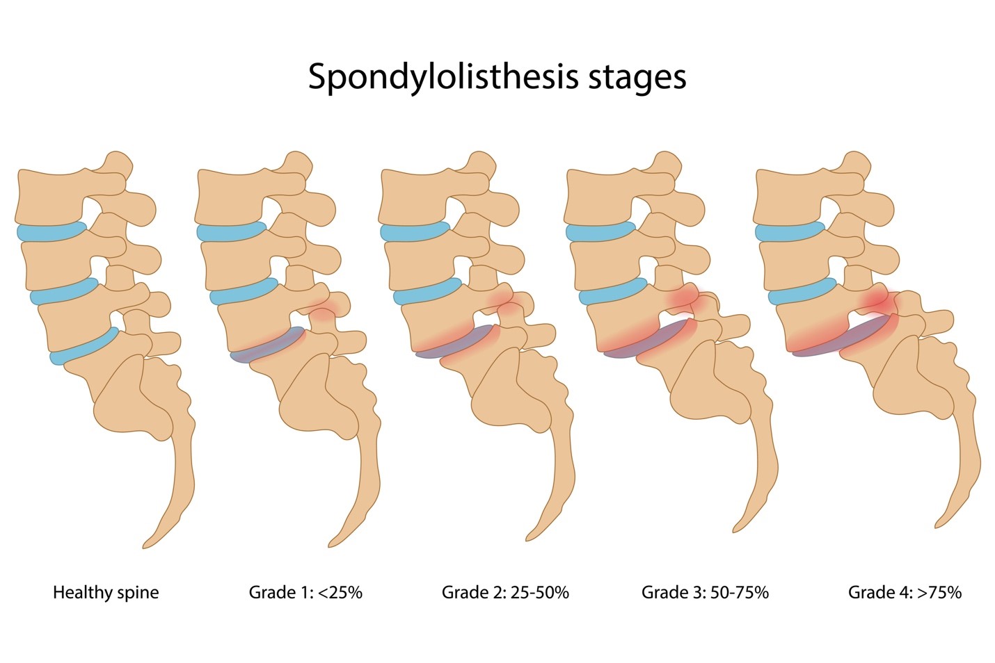 Spondylolisthesis (Degenerative) - Upswing Health | Upswing Health