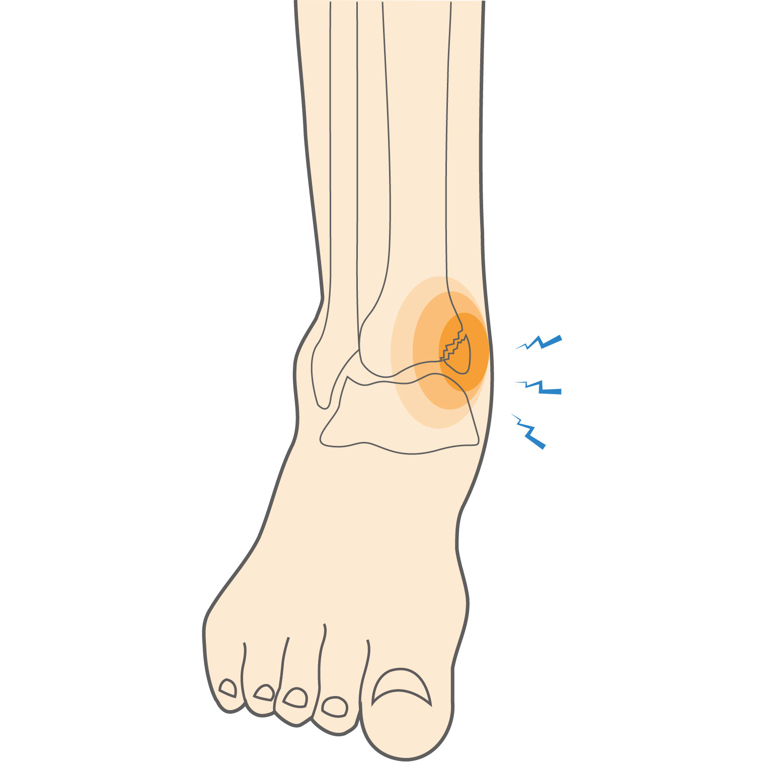 Ankle Fractures (Medial) Hero Image 2