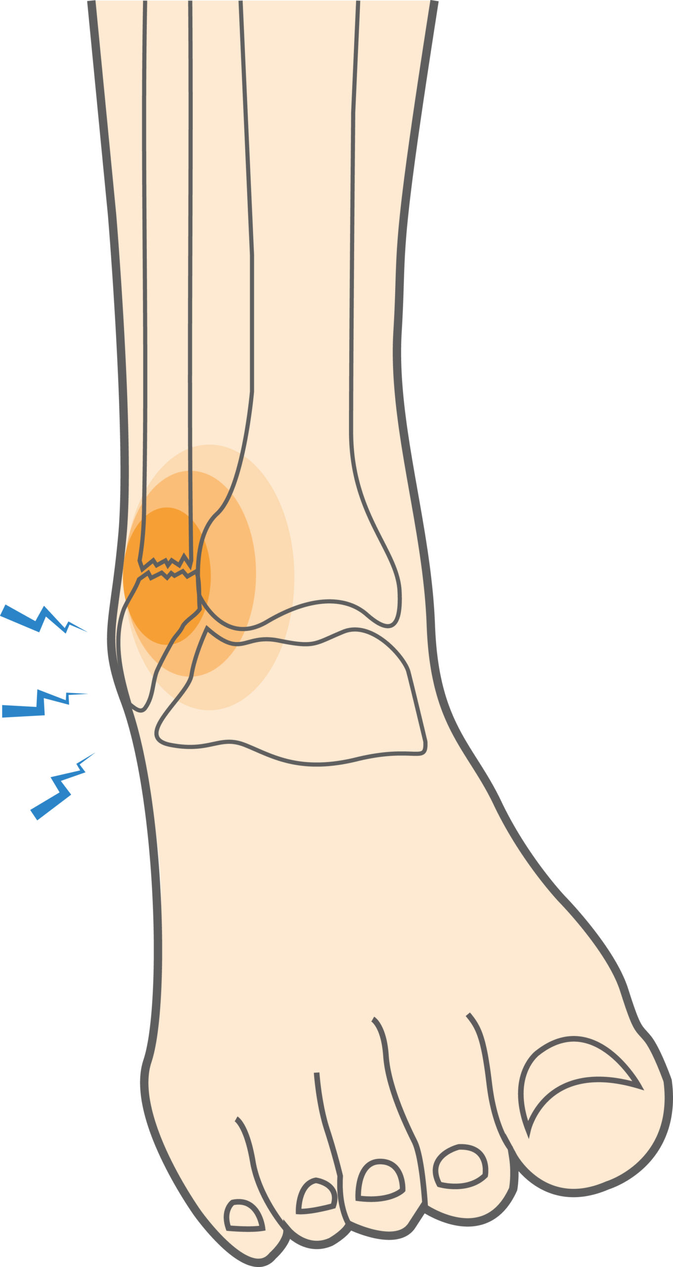 Ankle Fractures (Fibula) Hero Image 2