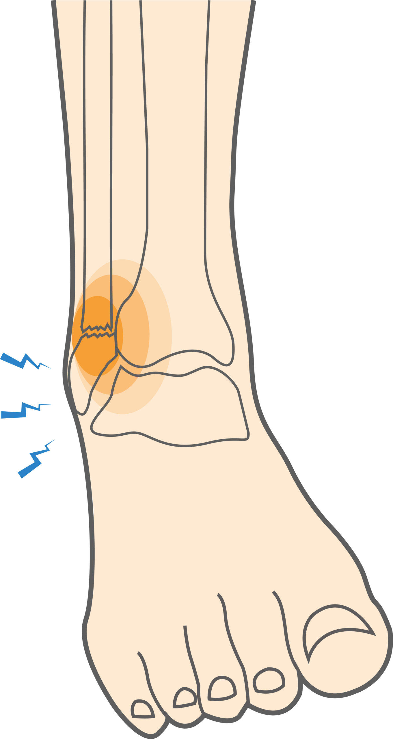 What are Ankle Fibula Fractures & How Are They Treated? - Upswing Health